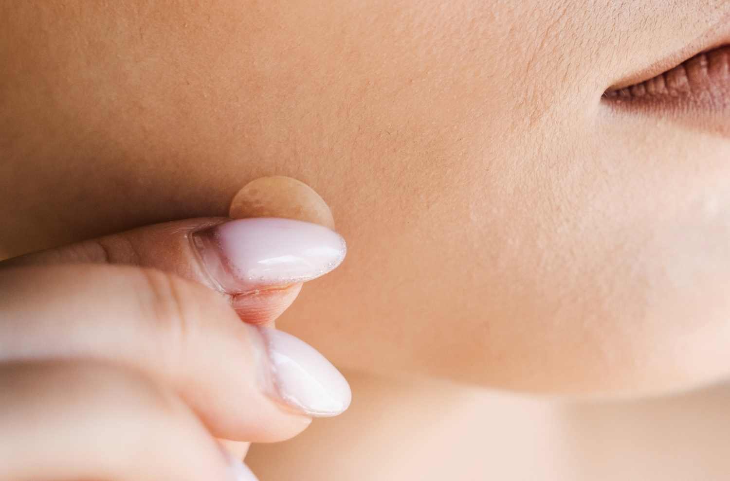 Acne vs. Rosacea: Tips for Identifying and Managing Your Condition